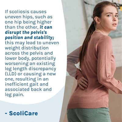 A visual representation of the quote from the text starting with “ If scoliosis causes uneven “