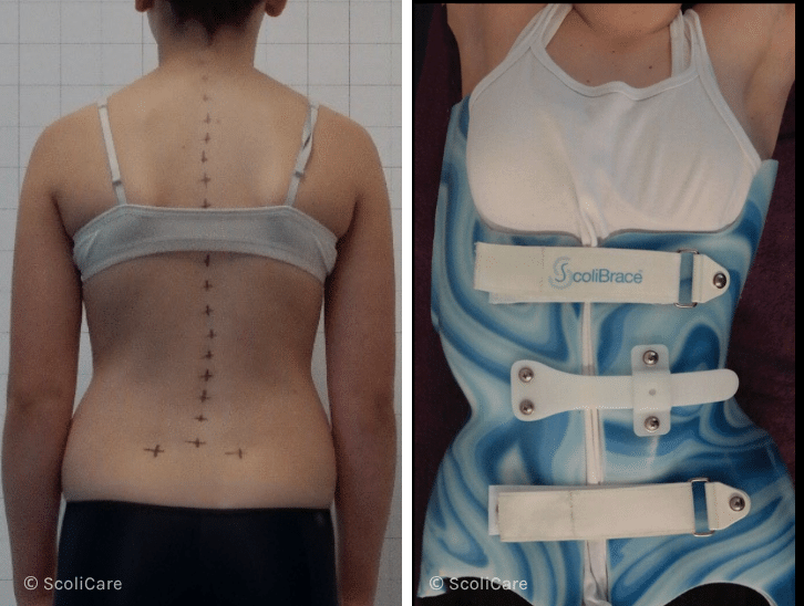 Case – Juvenille Bracing (12 year old female)