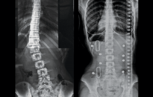 Bracing has been used as an early intervention treatment for scoliosis for decades. Over the years the way that scoliosis braces are designed and manufactured has evolved.