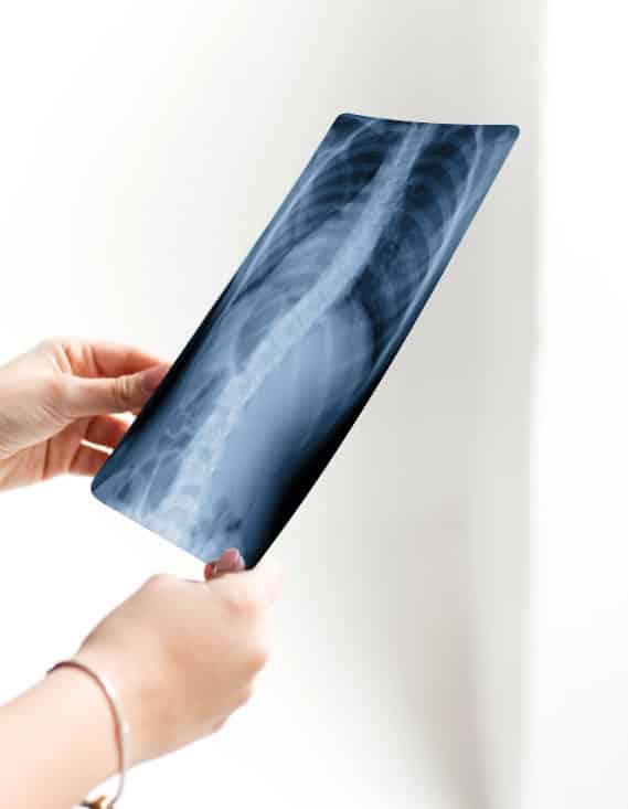 3D designed and manufactured scoliosis braces have been developed.