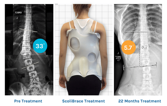 ScoliBrace Treatment