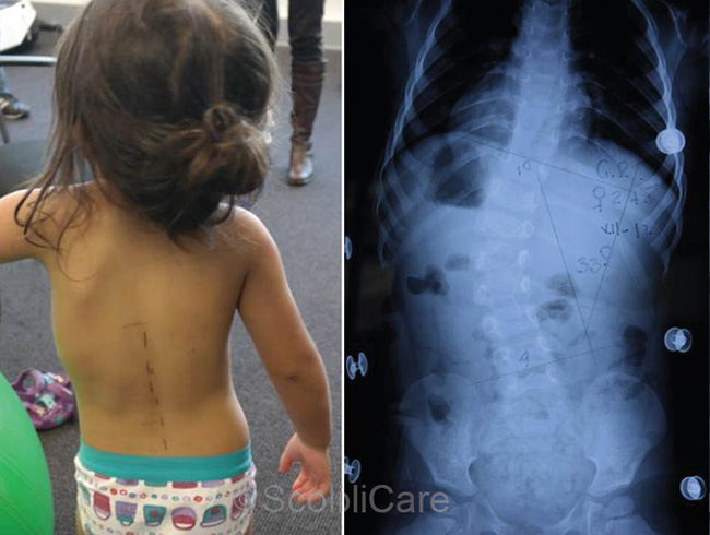 Case – Infantile Bracing (3 year old female)