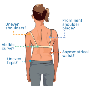 Teenager Scoliosis Signs
