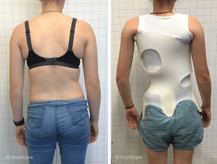 Case – Adolescent Bracing (14 year old female)