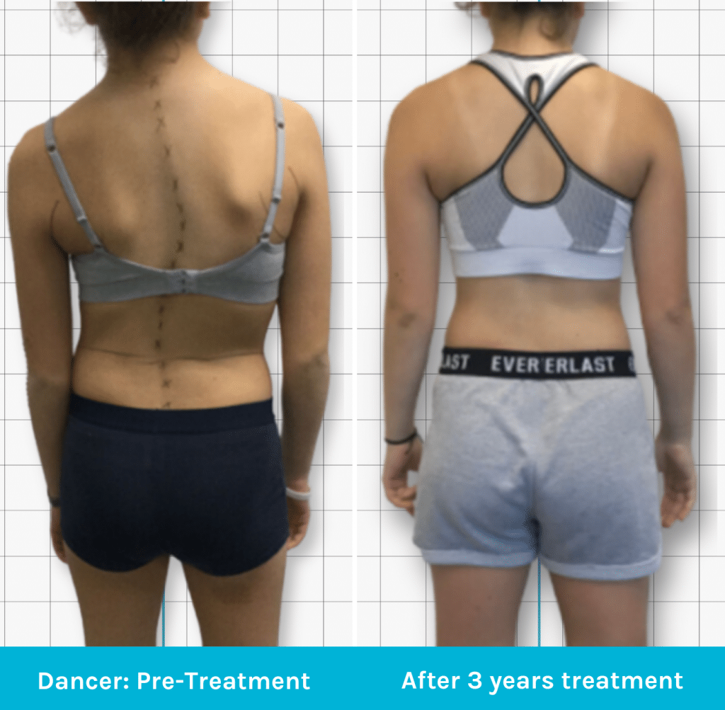 Dancer after 3 years treatment
