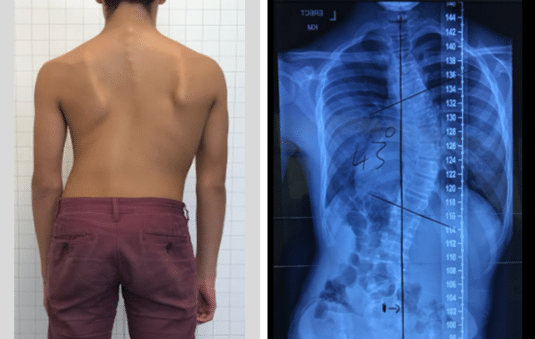 Case – Adolescent Bracing (12 year old male)