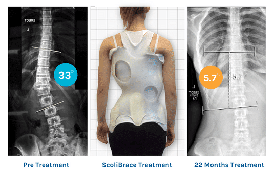 ScoliBrace Treatment