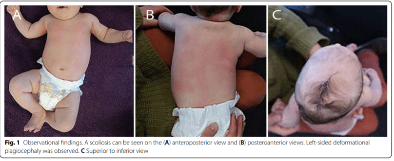 Infant Case Study