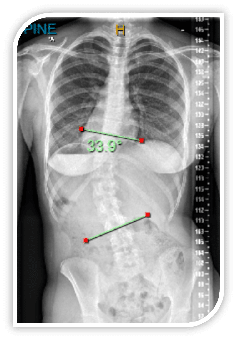 Figure 2- X-Ray at initial assessment at ScoliCare 
