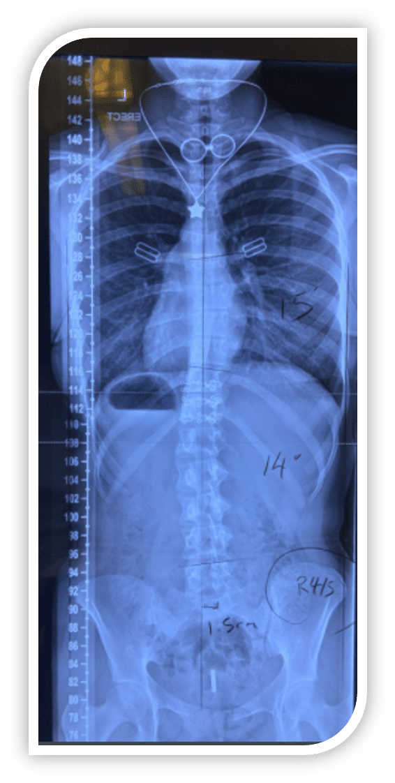  Figure 9- Out of brace X-ray at 12 months