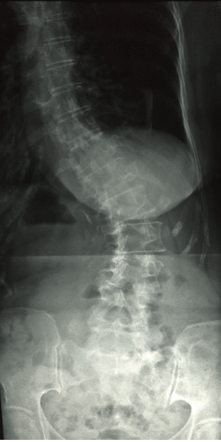 Adult Degenerative Scoliosis