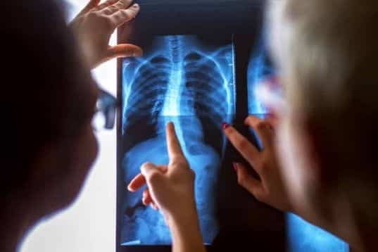 Scoliosis research