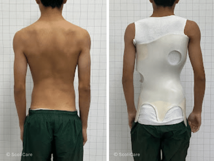 Case – Adolescent Bracing (16 year old male)