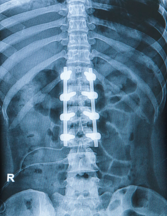 scoliosis surgery
