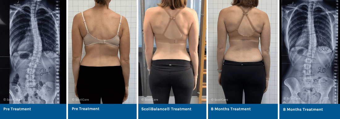 Treatment of scoliosis using the ScoliBalance® Program in an Adult Female Patient 