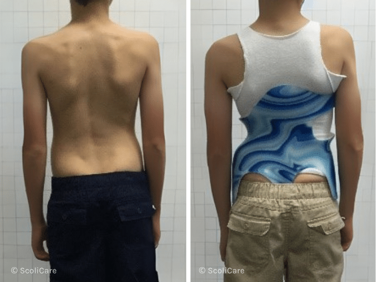 Case – Juvenille Bracing (11 year old male)