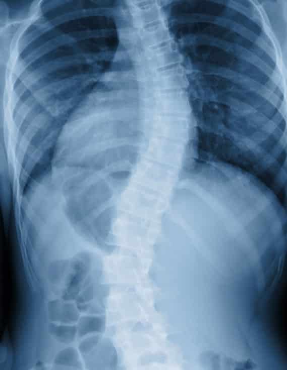Scoliosis