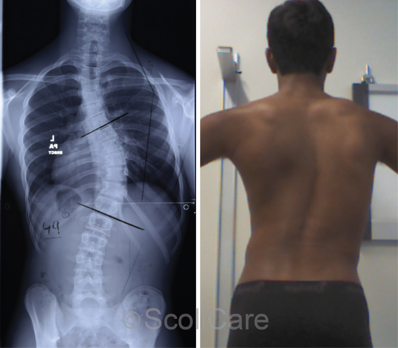 Case – Adolescent Bracing (14 year old male)