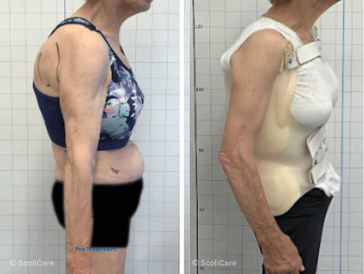 Case – Adult Bracing (78 year old female)