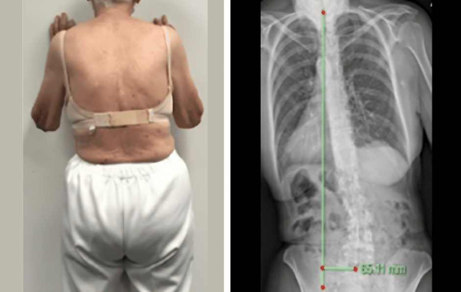 Case – Adult Bracing (87 year old female)