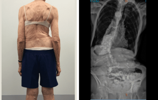 Case – Adult Bracing (88 year old female)