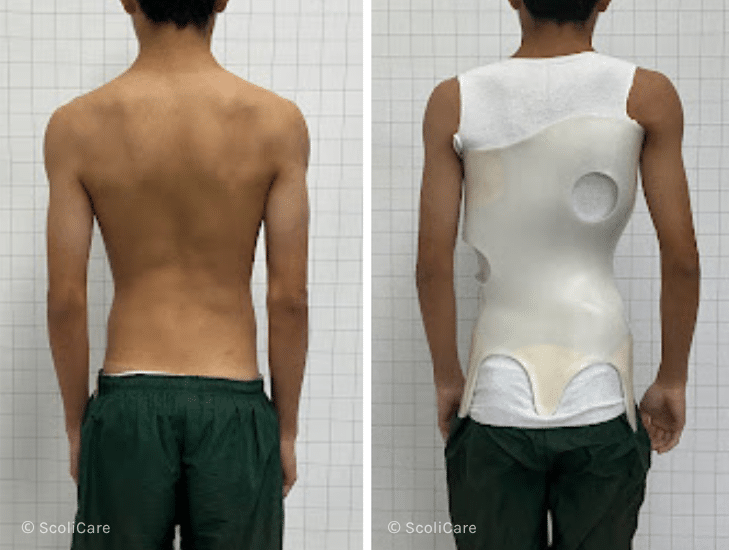 Case – Adolescent Bracing (16 year old male)