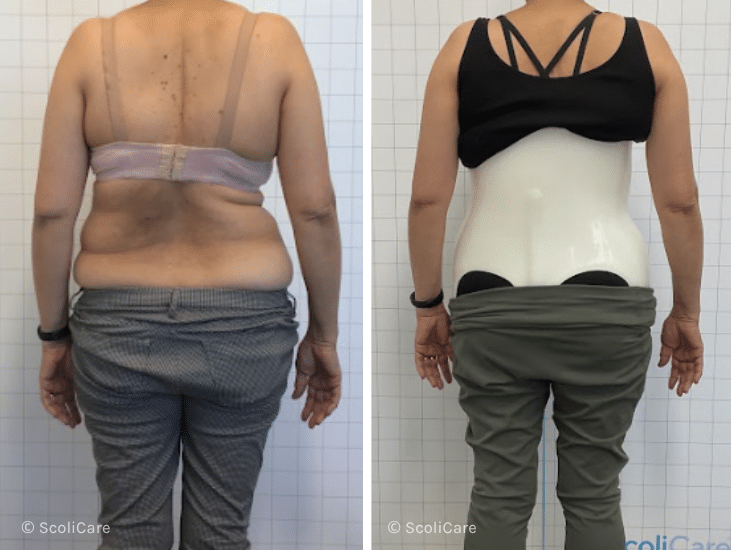 Case – Adult Bracing (61 year old female)