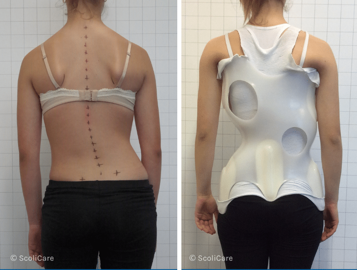 Case – Adolescent Bracing (13 year old female)