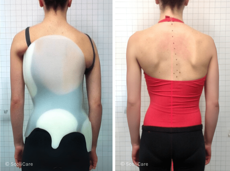 Case – Adolescent Bracing (17 year old female)
