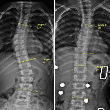 Juvenile Bracing Case