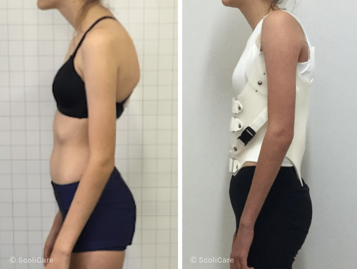 Case – Adolescent bracing (14 year old female)