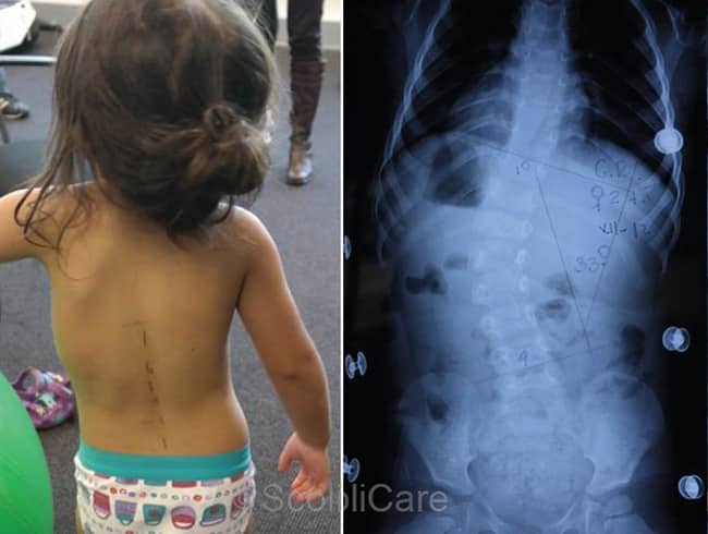 Case – Infantile Bracing (3 year old female)