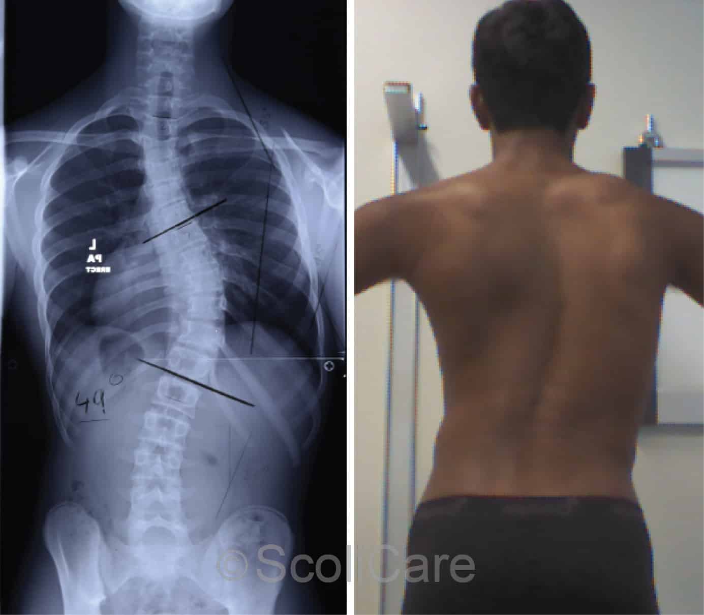 Bad Scoliosis X Ray