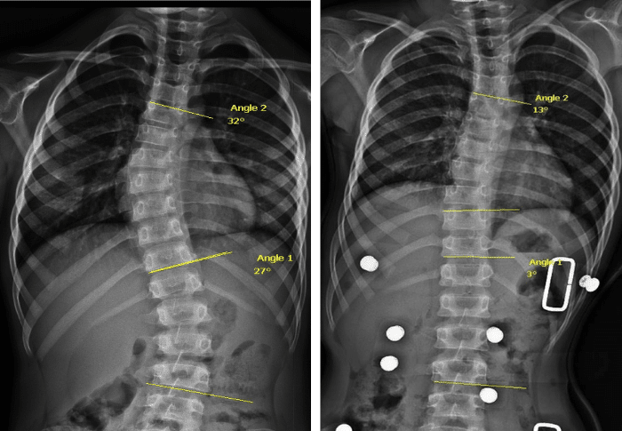 In-brace correction achieved with a custom 3D designed scoliosis brace compared with a standard TLSO in a juvenile scoliosis patient