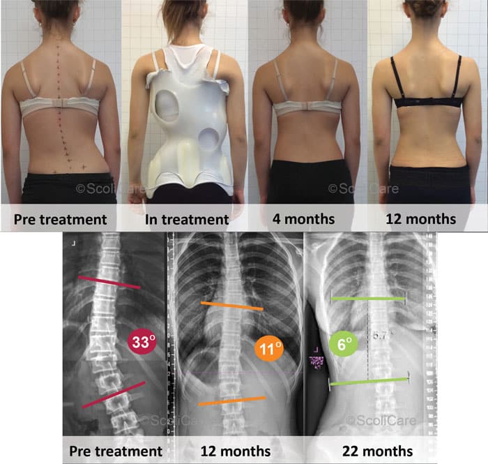 ScoliBrace custom braces treating scoliosis patients of all ages – ScoliCare