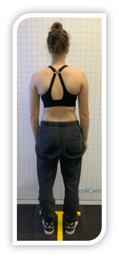 Figure-10-Postural-photo-at-12-months