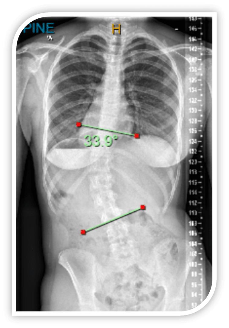 Figure 2- X-Ray at initial assessment at ScoliCare 