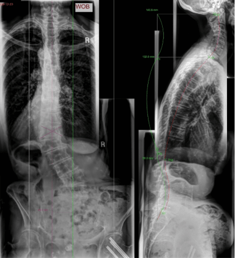 Adult Scoliosis Figure 1