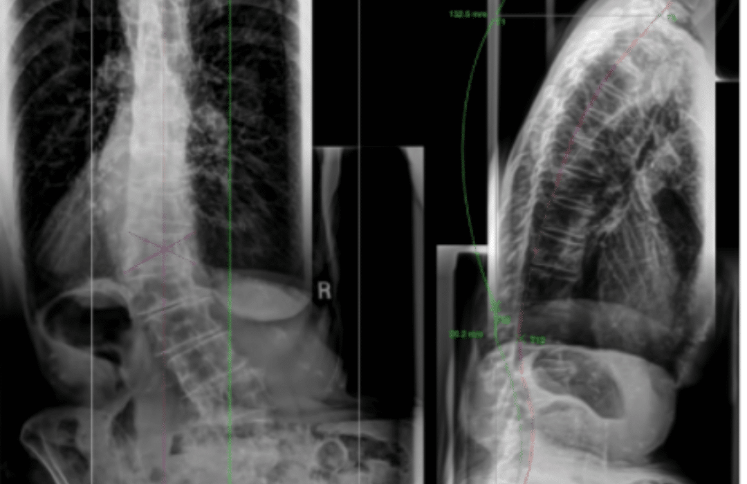 Adult Scoliosis Feature