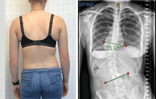 Reduction of Severe Scoliosis using a 3D designed custom scoliosis orthosis in a Young Active Female.