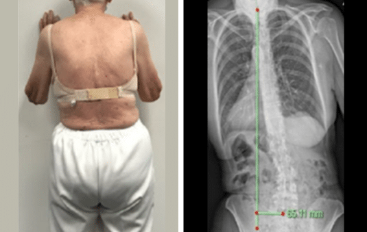 Case Image Treatment of a severe scoliosis using a 3D designed custom scoliosis brace in an Older Female Patient