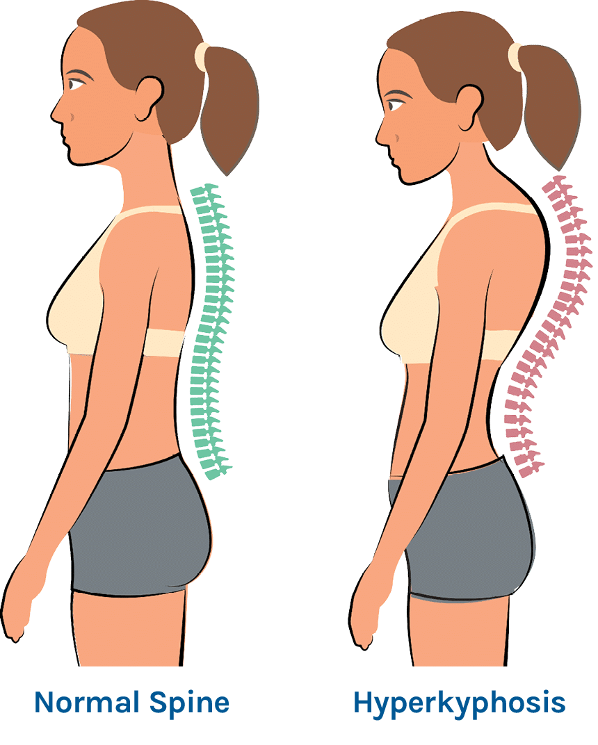 Hyperkyphosis