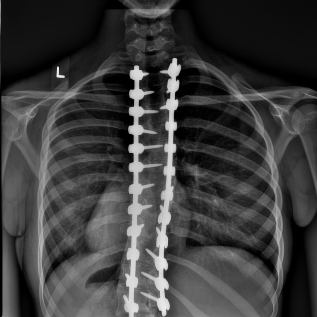 Spinal Fusion