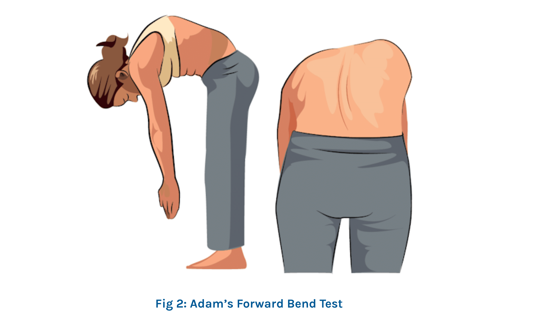 Adams Forward Bend Test