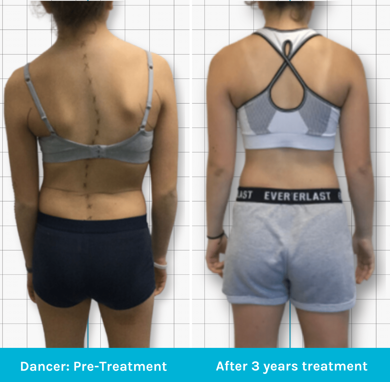 Scoliosis Treatment in Dancers