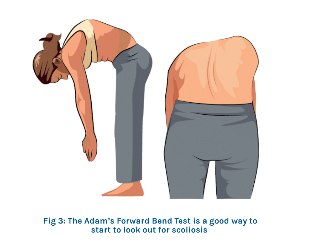 Adams Forward Bend Test