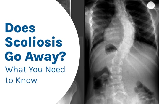 Does Scoliosis Go Away? What You Need to Know