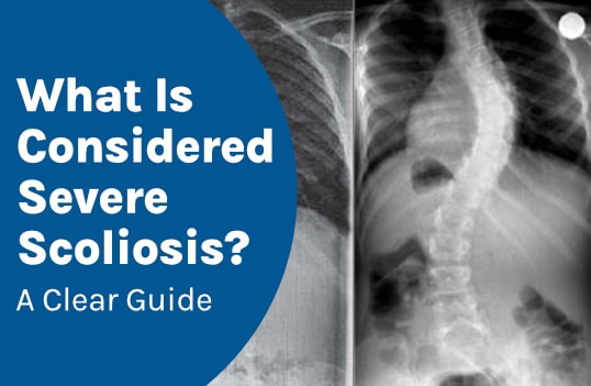 What Is Considered Severe Scoliosis? A Clear Guide