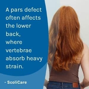 A visual representation of the quote from the text starting with “A pars defect is most common“